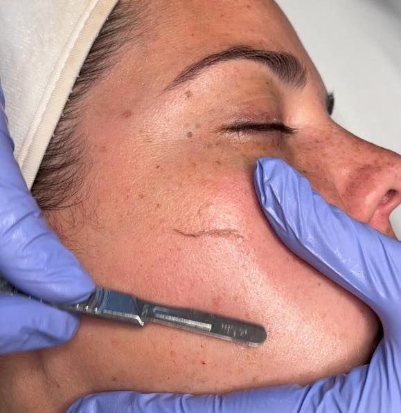 Hands using a metal tool to mark a cheek during a cosmetic skin treatment