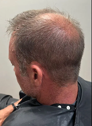 Back view of a man's head showing significant hair thinning and a pink scalp.