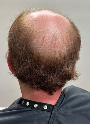Back of a balding person's head with thinning brown hair, seated in a chair with a dark collar.