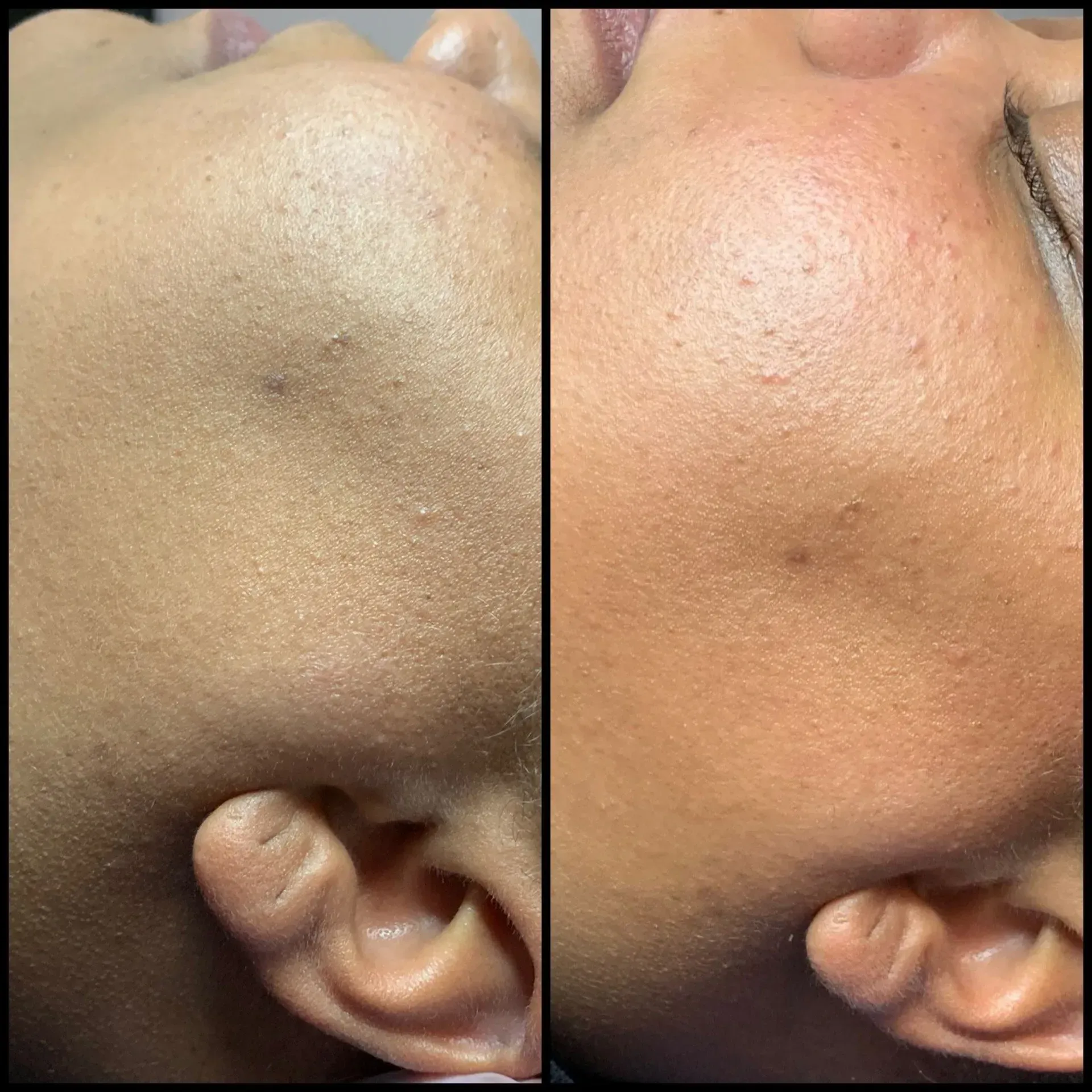Side-by-side close-up of a cheek with visible texture, before and after skin tone differences