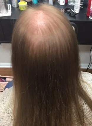 Thinning hair on the top and crown of a head, viewed from behind in a salon setting