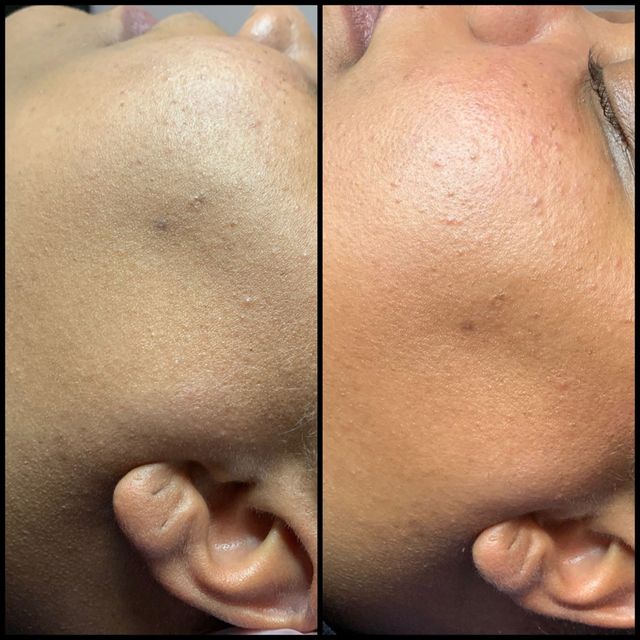 Side-by-side close-ups of a cheek showing before-and-after skin texture and tone