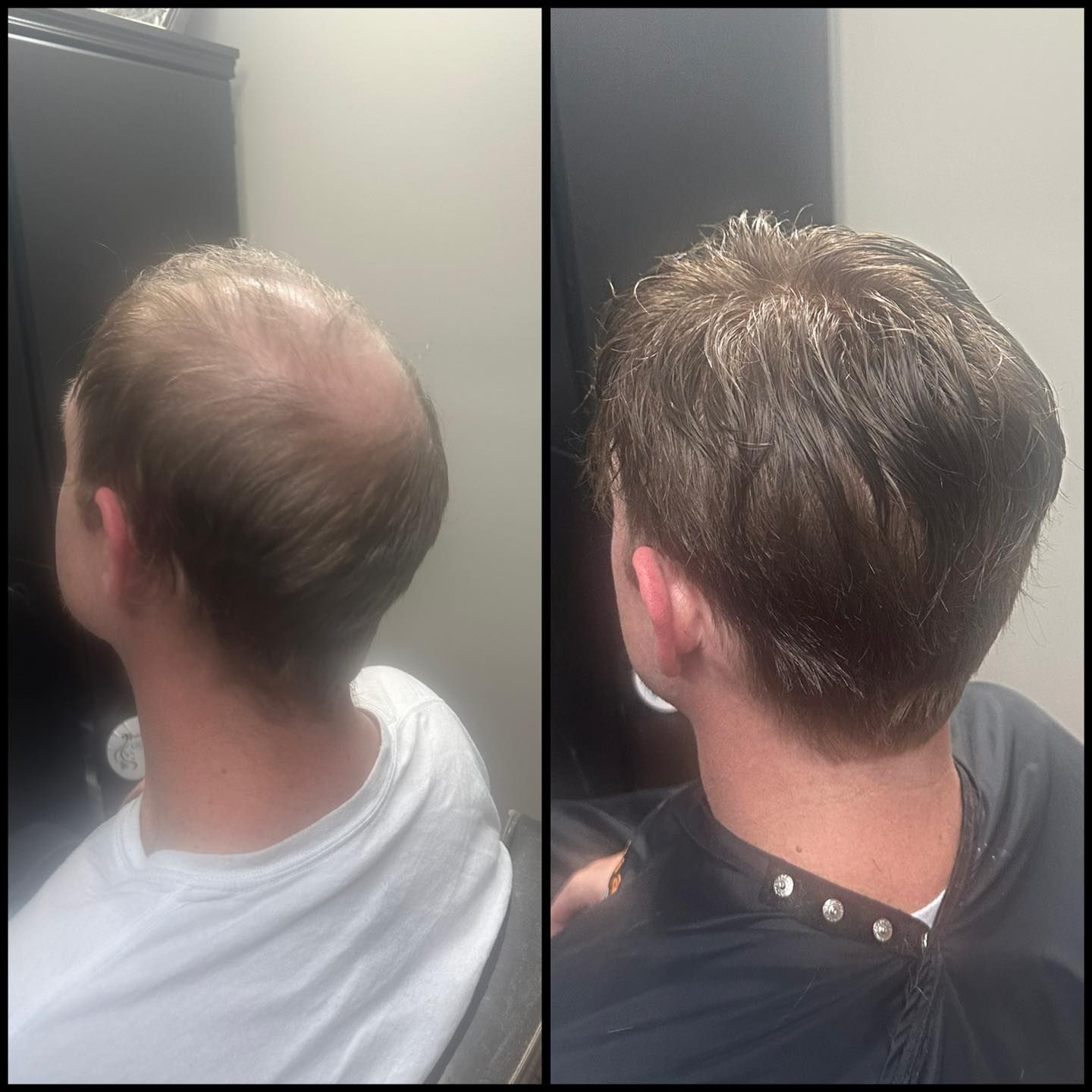 Side-by-side view of a man's head from behind, showing thinning hair on the left and denser hair on the right.